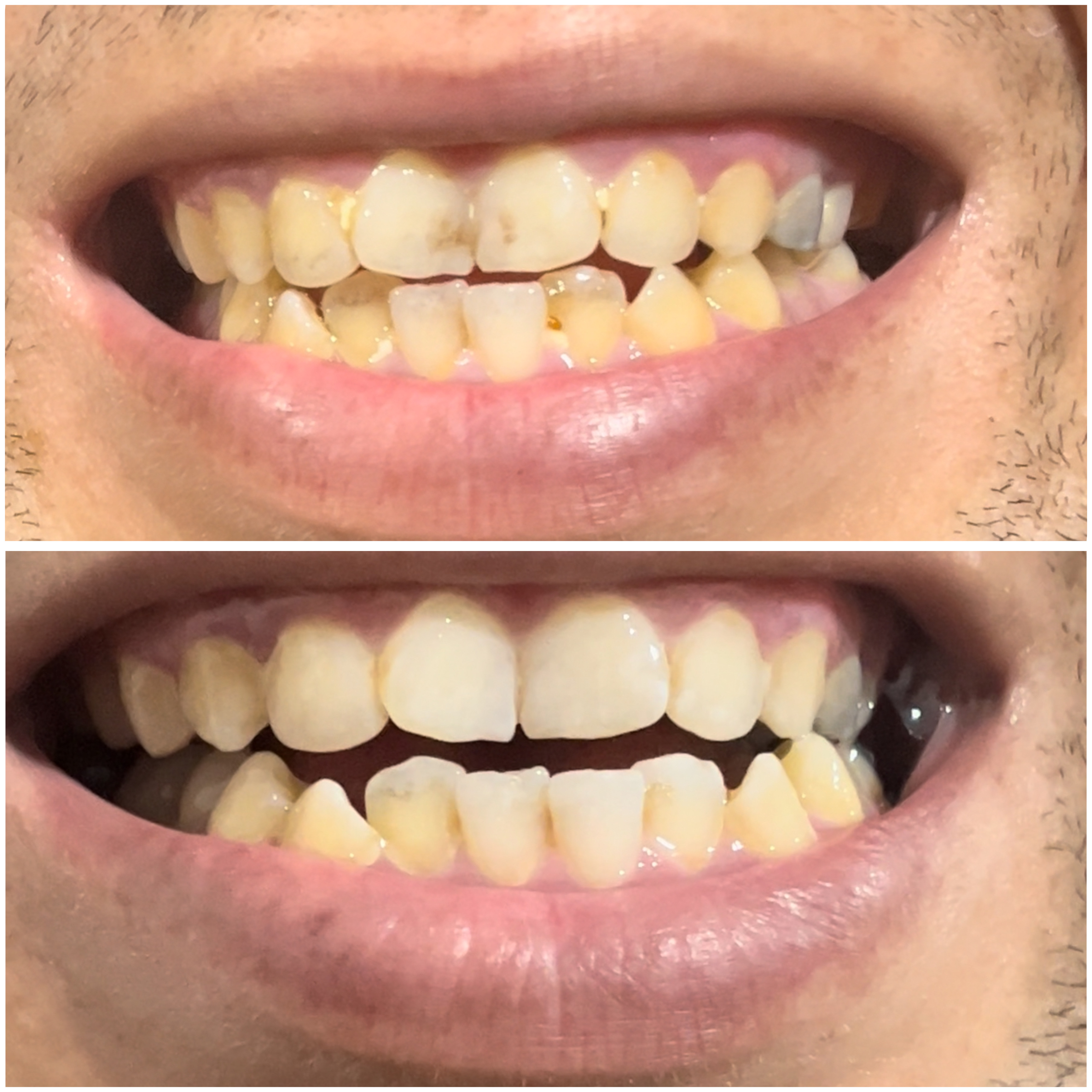 قطره سفید کننده دندان لانبنا