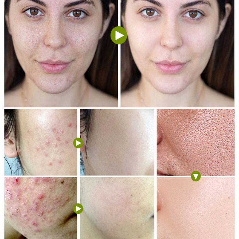 فوم شستشوی صورت ضدجوش لانبنا