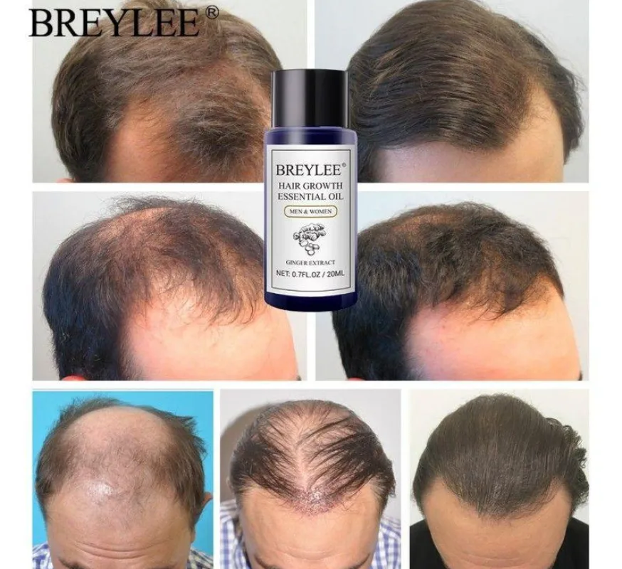 سرم ضدریزش بریلی